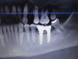 caso-cirugia-3-1