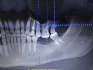 caso-cirugia-3-2