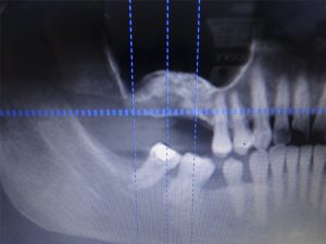 caso-cirugia-4-2