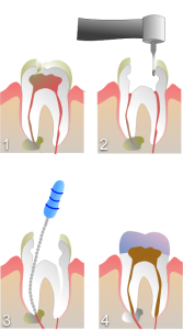 servicio-endodoncia