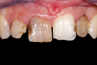 Smiling senior woman with new dental implants sitting in the dental office and looking at the mirror