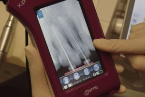 tratamiento-endodoncia