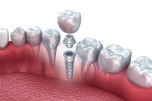 tratamiento-implantes-inmediatos