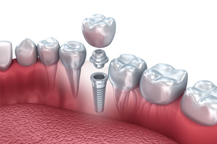 Smiling senior woman with new dental implants sitting in the dental office and looking at the mirror