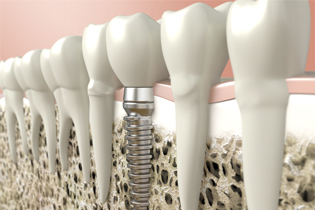 Smiling senior woman with new dental implants sitting in the dental office and looking at the mirror