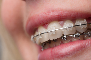 Smiling senior woman with new dental implants sitting in the dental office and looking at the mirror