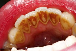 tratamiento-periodoncia